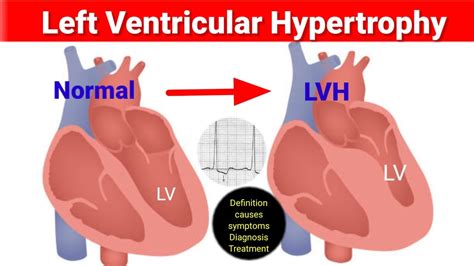 lv of heart|how does htn cause lvh.